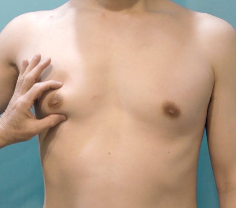 Male Breast Reduction (Gynecomastia Surgery) thumbnail 4