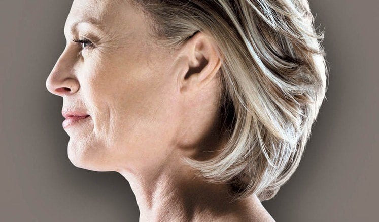 Neck Lift (Platysmaplasty) thumbnail 4