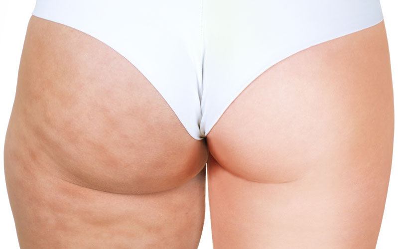 Thigh Lift (Thighplasty) thumbnail 3