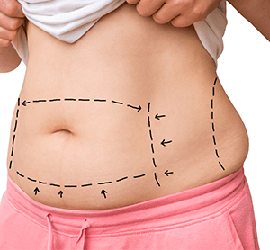 Liposuction (Lipoplasty) - Dr. Gideon Maresky Cape Town