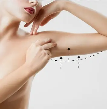 Arm Lift (Brachioplasty) procedure reference image