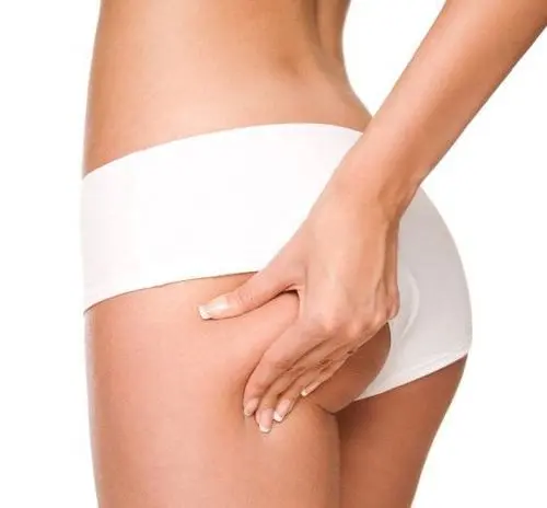 Body Lift (Belt Lipectomy) procedure reference image