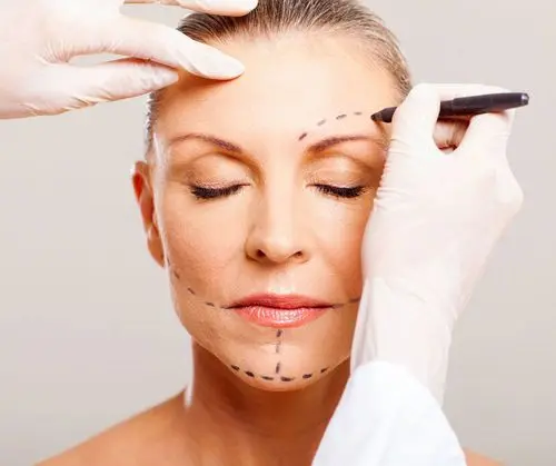 Facelift (Rhytidectomy) procedure reference image