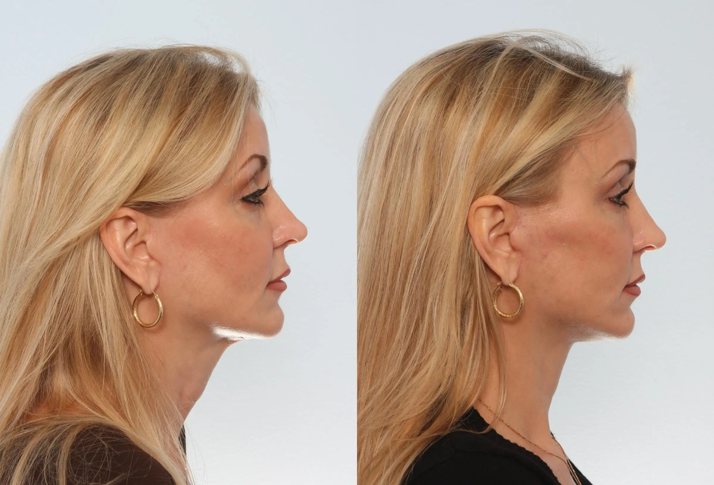 Neck Lift (Platysmaplasty) before and after
