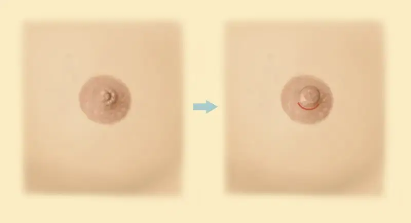 Nipple Surgery (Nipple Correction) before and after