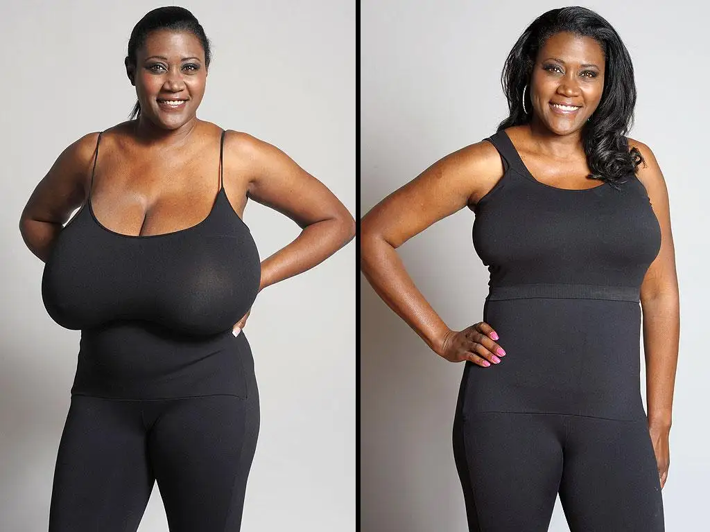 Breast Reduction (Reduction Mammoplasty) before and after