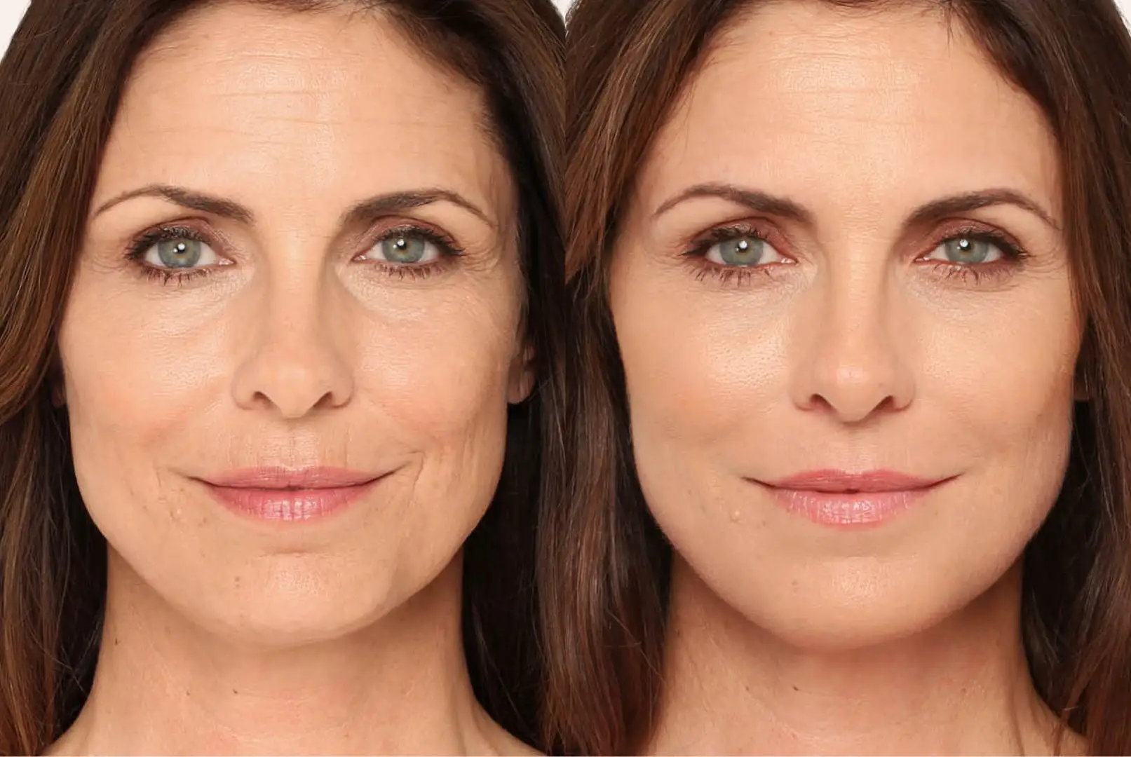 Facial Fillers (Dermal Filler Injections) before and after