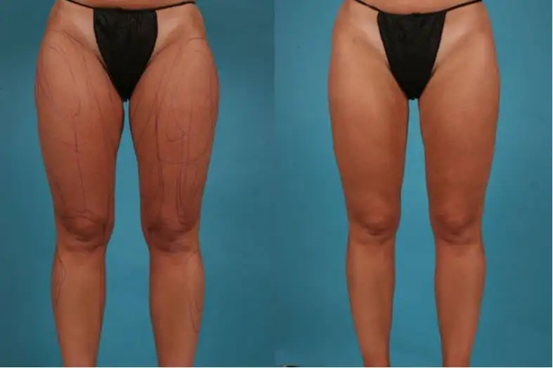 Thigh Lift (Thighplasty) before and after