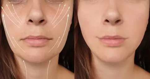 Thread Lift (PDO Thread Lift) before and after