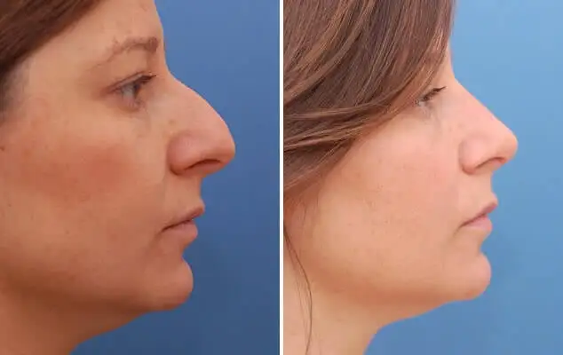 Nose Job (Rhinoplasty) before and after