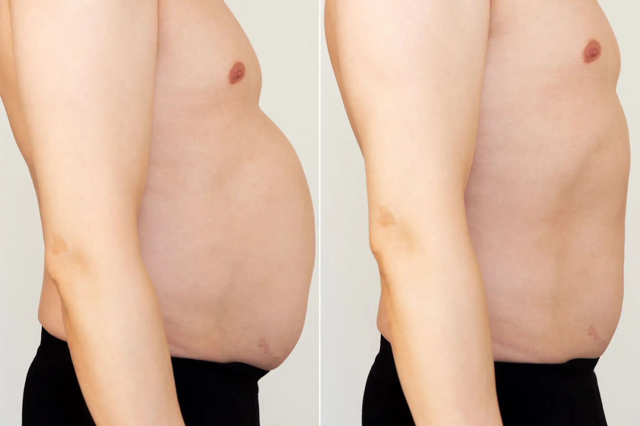 Liposuction (Lipoplasty) before and after