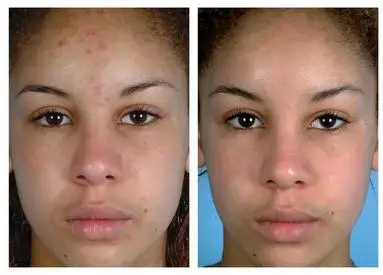 Microdermabrasion (Mechanical Exfoliation) before and after