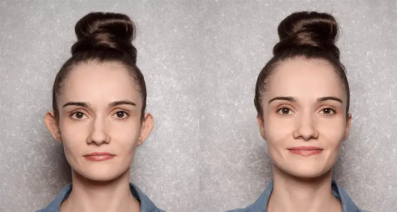 Otoplasty before and after