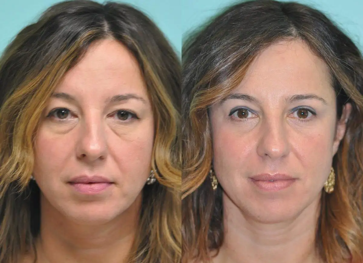 Eyelid Lift (Blepharoplasty) before and after