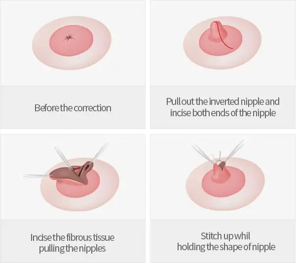 Nipple Surgery (Nipple Correction) - Image 2 of 4
