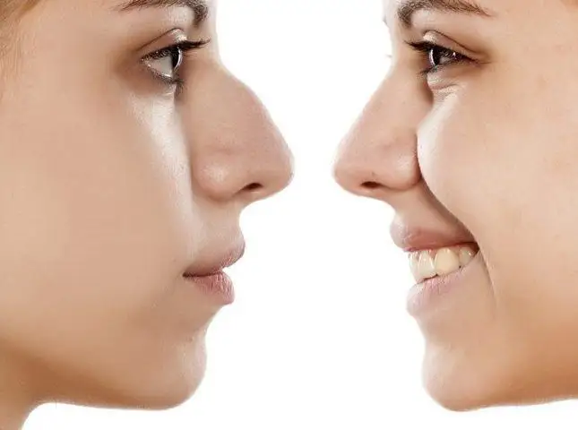 Nose Job (Rhinoplasty) - Image 2 of 4