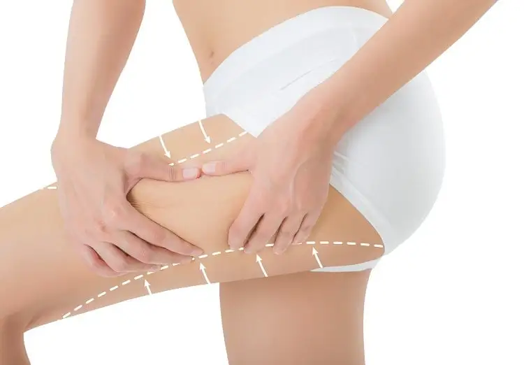 Thigh Lift (Thighplasty) - Image 2 of 5