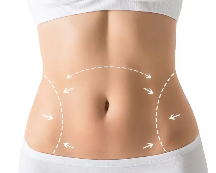 Tummy Tuck (Abdominoplasty) - Image 2 of 6