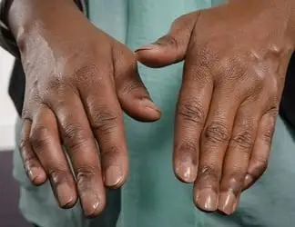 Carpal Tunnel Surgery (Carpal Tunnel Release) - Image 3 of 5