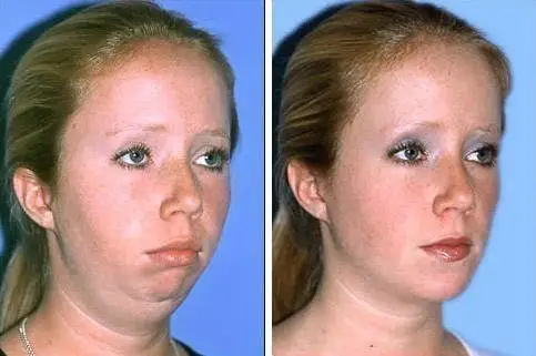 Chin Augmentation (Mentoplasty) - Image 3 of 4