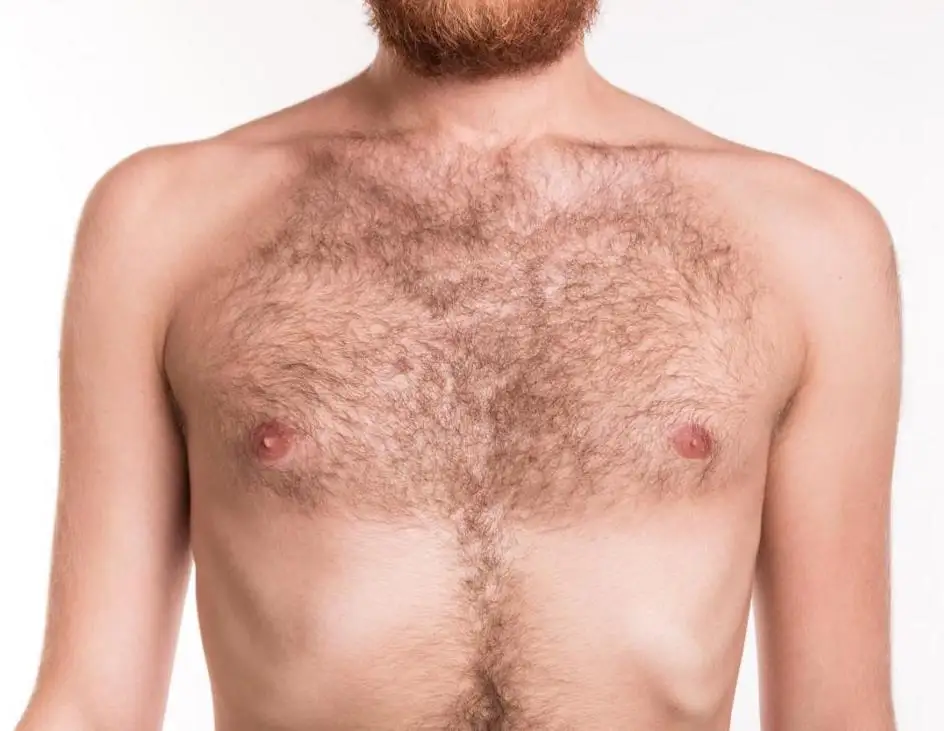 Male Breast Reduction (Gynecomastia Surgery) - Image 3 of 4