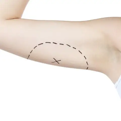 Arm Lift (Brachioplasty) - Image 4 of 4