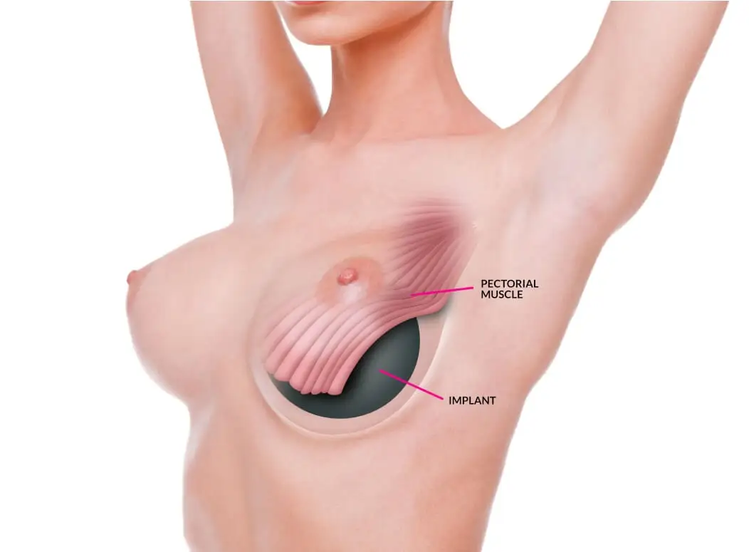 Breast Enlargement (Augmentation Mammoplasty) - Image 4 of 5