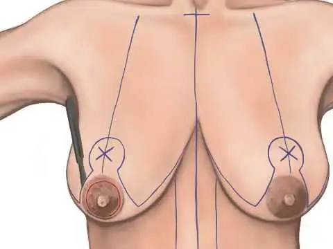 Breast Lift (Mastopexy) - Image 4 of 4