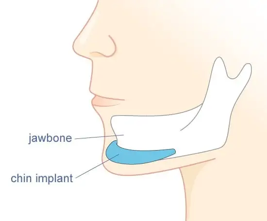 Chin Augmentation (Mentoplasty) - Image 4 of 4