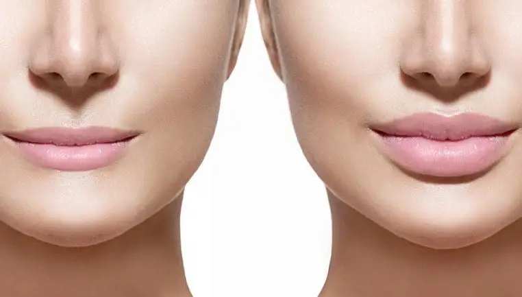 Lip Fillers (Dermal Filler Injections) - Image 4 of 4