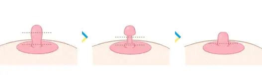 Nipple Surgery (Nipple Correction) - Image 4 of 4