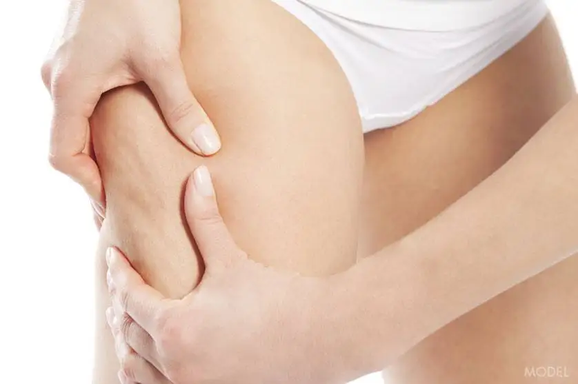 Thigh Lift (Thighplasty) - Image 4 of 5