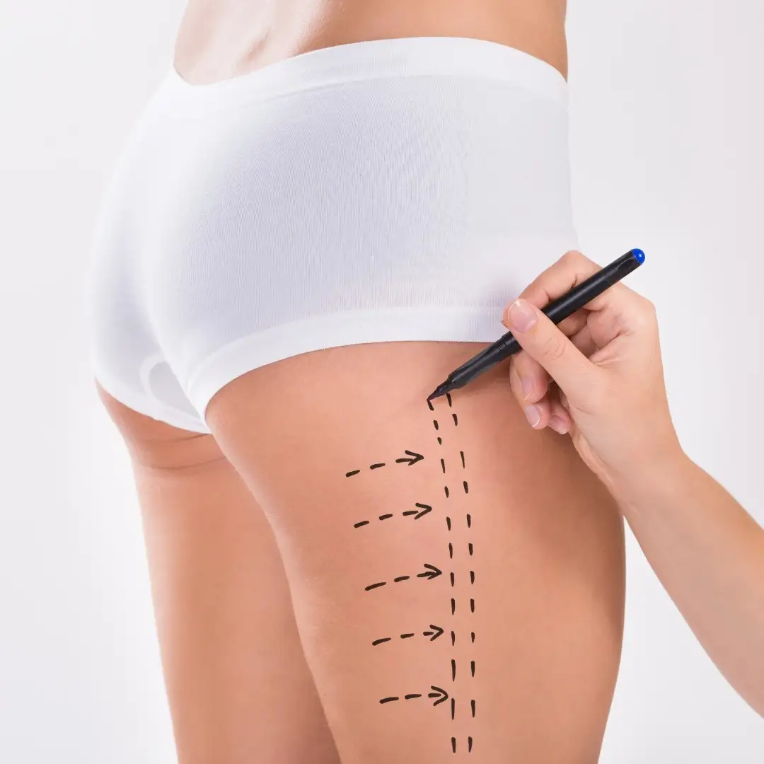 Thigh Lift (Thighplasty) - Image 5 of 5