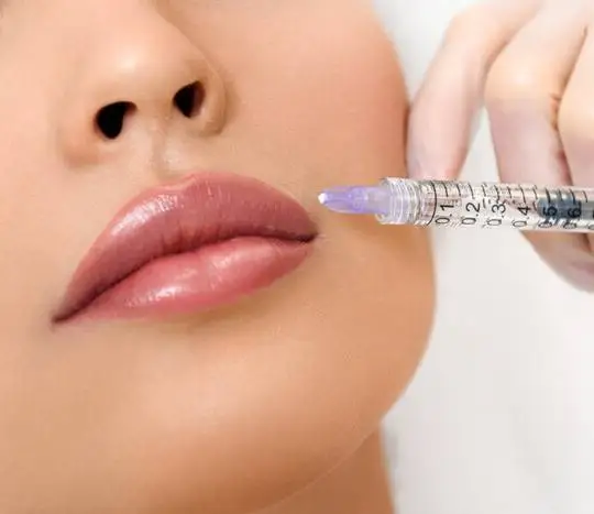Fat Transfer (Autologous Fat Grafting) - Image 5 of 5