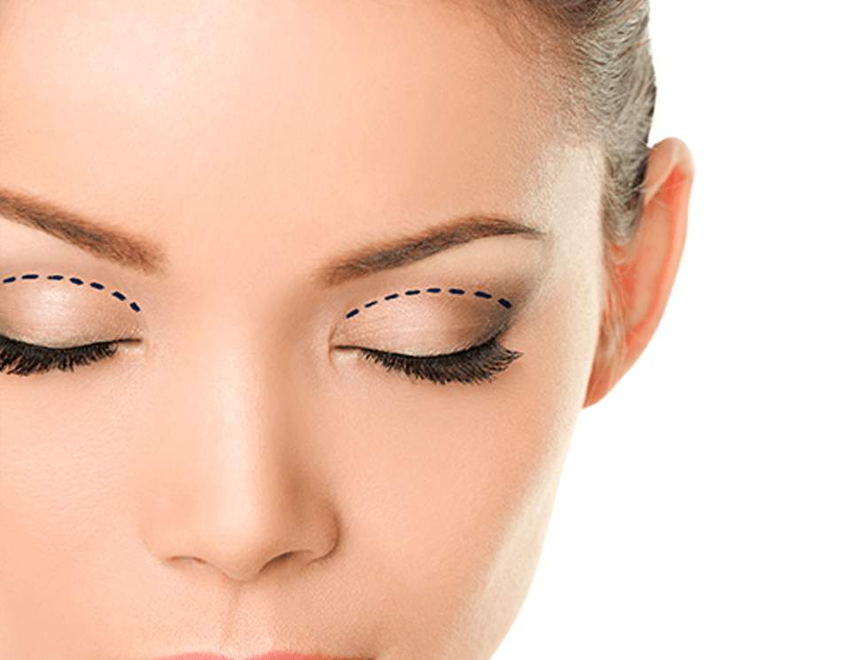 Blepharoplasty (Eyelid Surgery)
