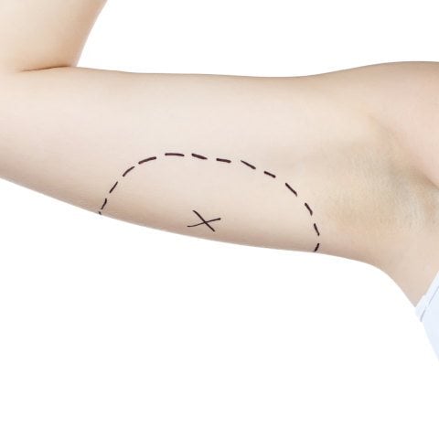 Arm Lift (Brachioplasty) thumbnail 4