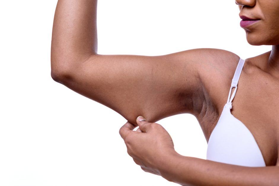 Arm Lift (Brachioplasty) thumbnail 3