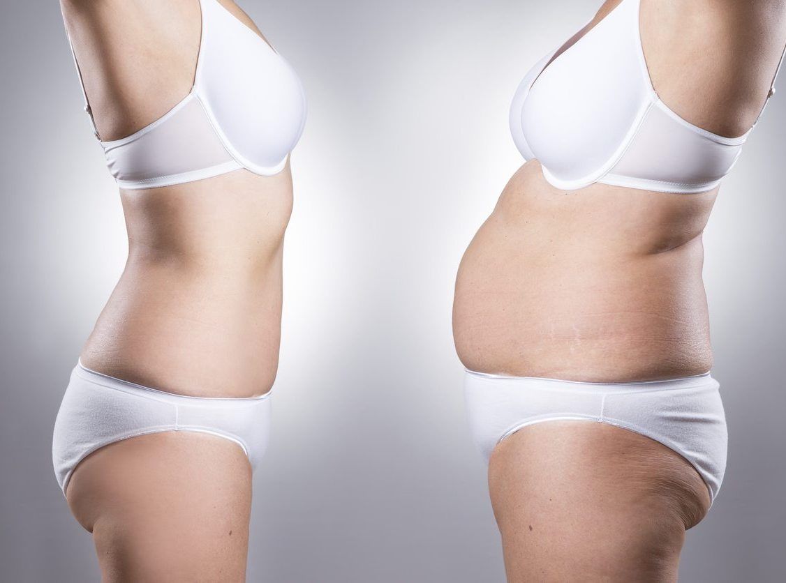 Body Lift (Belt Lipectomy) thumbnail 3