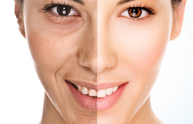 Chemical Peels (Chemexfoliation) thumbnail 2