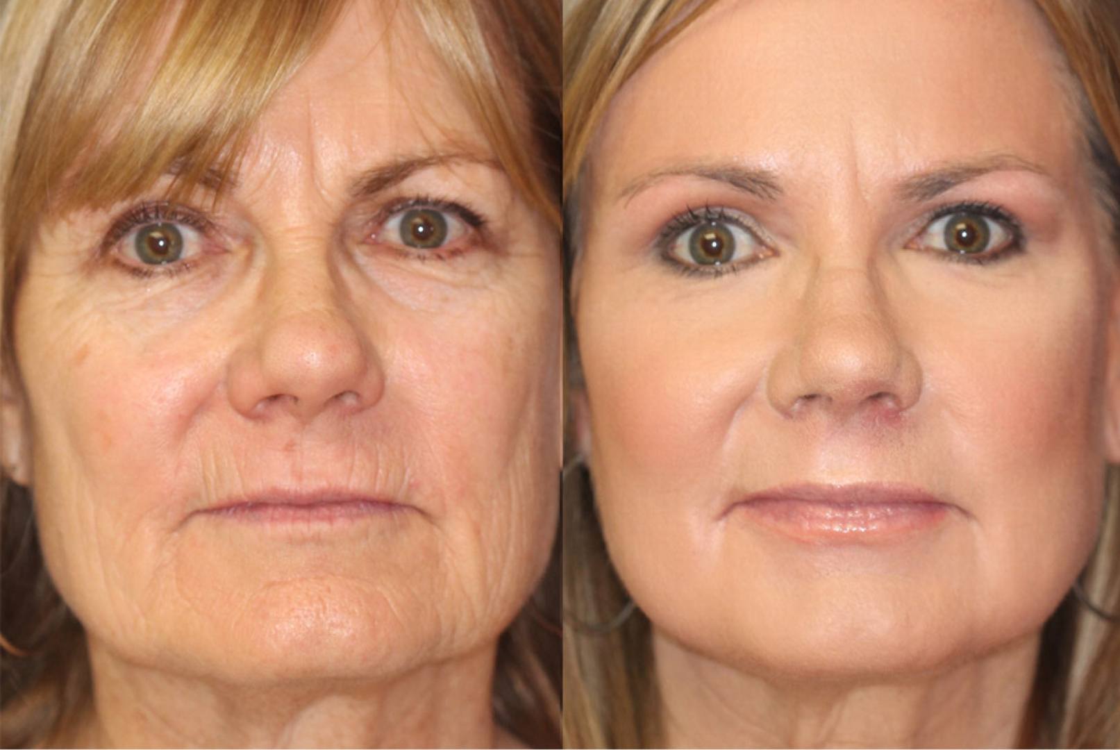 Chemical Peels (Chemexfoliation) thumbnail 3