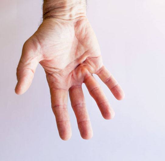 Dupuytren's Contracture (Fasciectomy) thumbnail 3