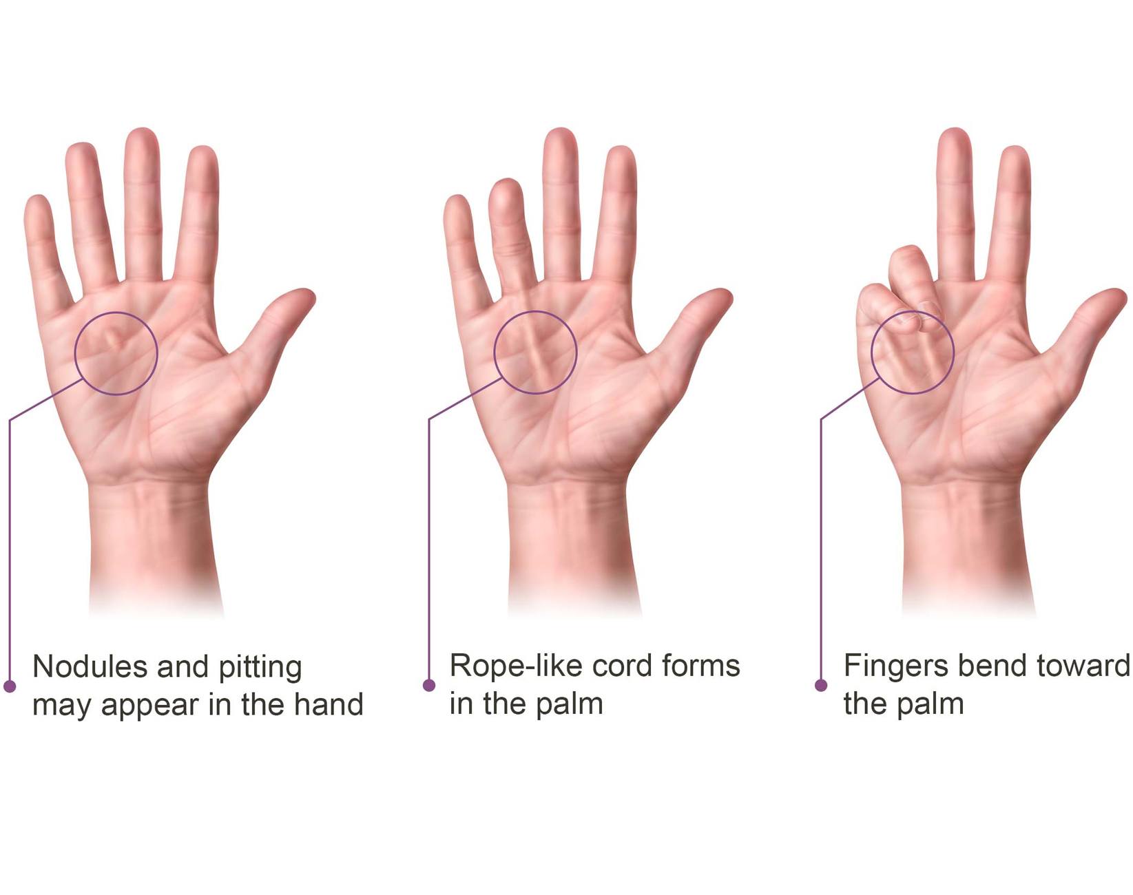 Dupuytren's Contracture (Fasciectomy) thumbnail 2