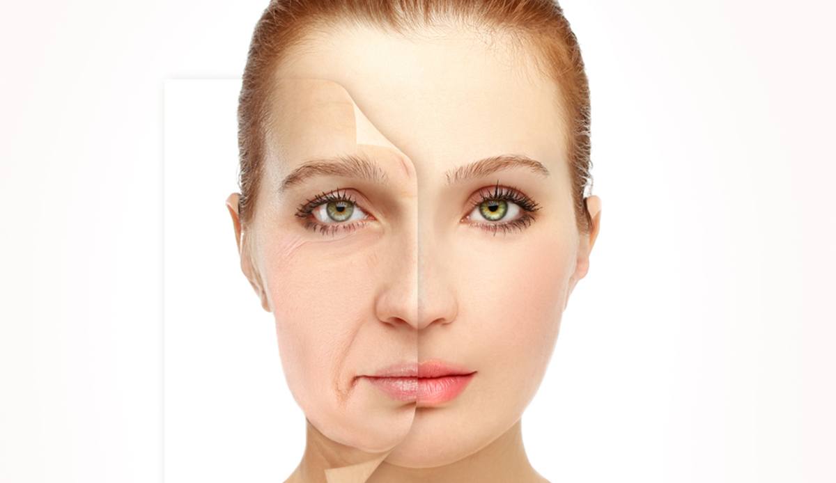 Facelift (Rhytidectomy) thumbnail 3