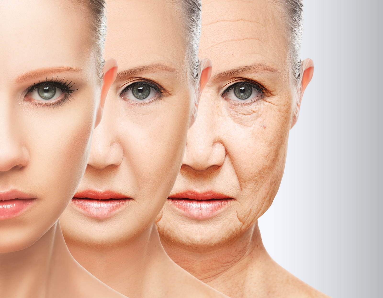 Facelift (Rhytidectomy) thumbnail 4