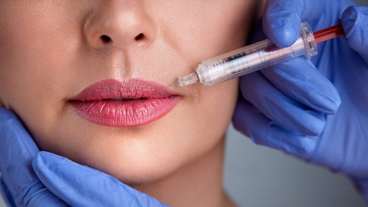 Lip Fillers (Dermal Filler Injections) thumbnail 3