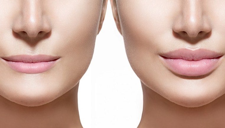 Lip Fillers (Dermal Filler Injections) thumbnail 4
