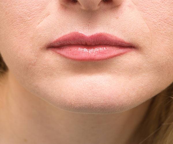 Lip Reduction (Cheiloplasty) thumbnail 3