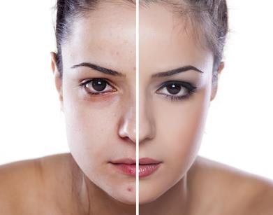 Microdermabrasion (Mechanical Exfoliation) thumbnail 4