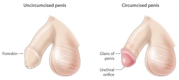 Baby Circumcision (Neonatal Circumcision) thumbnail 3