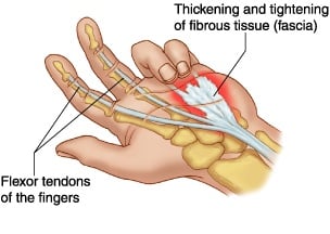 Dupuytren's Contracture (Fasciectomy) thumbnail 4